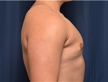 Male Breast Reduction After Photo by Michael Frederick, MD; Fort Lauderdale, FL - Case 35952