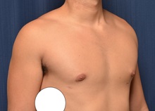 Male Breast Reduction After Photo by Michael Frederick, MD; Fort Lauderdale, FL - Case 35960