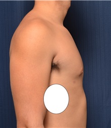 Male Breast Reduction After Photo by Michael Frederick, MD; Fort Lauderdale, FL - Case 35960