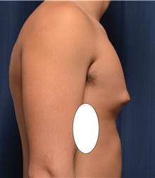 Male Breast Reduction Before Photo by Michael Frederick, MD; Fort Lauderdale, FL - Case 35960