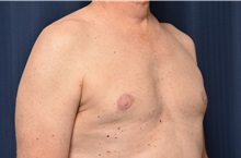 Male Breast Reduction After Photo by Michael Frederick, MD; Fort Lauderdale, FL - Case 35962