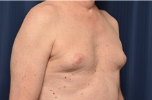 Male Breast Reduction Before Photo by Michael Frederick, MD; Fort Lauderdale, FL - Case 35962