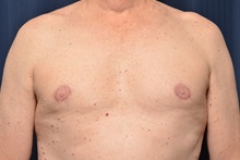 Male Breast Reduction After Photo by Michael Frederick, MD; Fort Lauderdale, FL - Case 35962