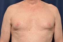 Male Breast Reduction Before Photo by Michael Frederick, MD; Fort Lauderdale, FL - Case 35962