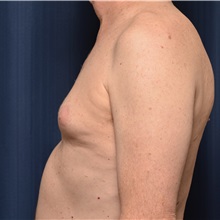 Male Breast Reduction Before Photo by Michael Frederick, MD; Fort Lauderdale, FL - Case 35962