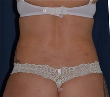 Liposuction After Photo by Michael Frederick, MD; Fort Lauderdale, FL - Case 36011