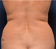 Liposuction Before Photo by Michael Frederick, MD; Fort Lauderdale, FL - Case 36011