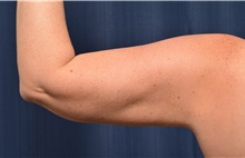 Liposuction After Photo by Michael Frederick, MD; Fort Lauderdale, FL - Case 36012