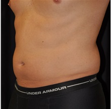 Liposuction Before Photo by Michael Frederick, MD; Fort Lauderdale, FL - Case 36014
