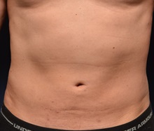 Liposuction After Photo by Michael Frederick, MD; Fort Lauderdale, FL - Case 36014