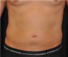 Liposuction Before Photo by Michael Frederick, MD; Fort Lauderdale, FL - Case 36014