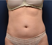 Liposuction Before Photo by Michael Frederick, MD; Fort Lauderdale, FL - Case 36015