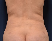 Liposuction After Photo by Michael Frederick, MD; Fort Lauderdale, FL - Case 36015