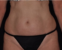 Liposuction Before Photo by Michael Frederick, MD; Fort Lauderdale, FL - Case 36017