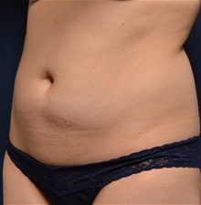 Liposuction Before Photo by Michael Frederick, MD; Fort Lauderdale, FL - Case 36048
