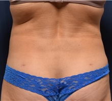 Liposuction After Photo by Michael Frederick, MD; Fort Lauderdale, FL - Case 36048