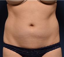 Liposuction Before Photo by Michael Frederick, MD; Fort Lauderdale, FL - Case 36048