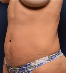 Liposuction After Photo by Michael Frederick, MD; Fort Lauderdale, FL - Case 36050