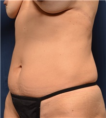 Liposuction Before Photo by Michael Frederick, MD; Fort Lauderdale, FL - Case 36050