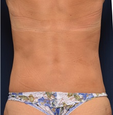 Liposuction After Photo by Michael Frederick, MD; Fort Lauderdale, FL - Case 36050