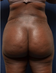 Liposuction After Photo by Michael Frederick, MD; Fort Lauderdale, FL - Case 36054