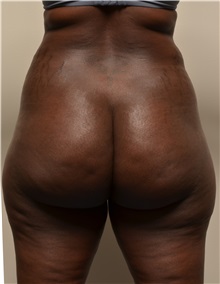 Liposuction Before Photo by Michael Frederick, MD; Fort Lauderdale, FL - Case 36054