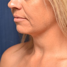 Liposuction After Photo by Michael Frederick, MD; Fort Lauderdale, FL - Case 36056