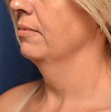 Liposuction Before Photo by Michael Frederick, MD; Fort Lauderdale, FL - Case 36056