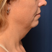 Liposuction Before Photo by Michael Frederick, MD; Fort Lauderdale, FL - Case 36056