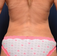 Liposuction After Photo by Michael Frederick, MD; Fort Lauderdale, FL - Case 36057