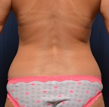 Liposuction Before Photo by Michael Frederick, MD; Fort Lauderdale, FL - Case 36057