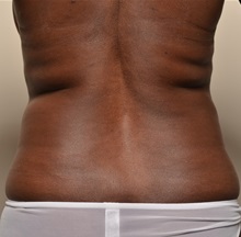 Liposuction Before Photo by Michael Frederick, MD; Fort Lauderdale, FL - Case 36060