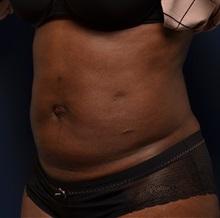 Liposuction After Photo by Michael Frederick, MD; Fort Lauderdale, FL - Case 36060