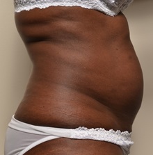 Liposuction Before Photo by Michael Frederick, MD; Fort Lauderdale, FL - Case 36060