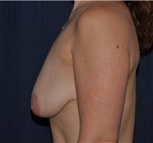 Breast Lift Before Photo by Michael Frederick, MD; Fort Lauderdale, FL - Case 36518