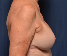Breast Lift After Photo by Michael Frederick, MD; Fort Lauderdale, FL - Case 36519