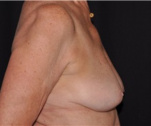 Breast Lift Before Photo by Michael Frederick, MD; Fort Lauderdale, FL - Case 36519