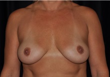 Breast Lift Before Photo by Michael Frederick, MD; Fort Lauderdale, FL - Case 36520