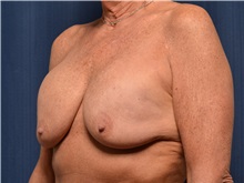 Breast Implant Revision Before Photo by Michael Frederick, MD; Fort Lauderdale, FL - Case 36523