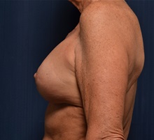 Breast Implant Revision After Photo by Michael Frederick, MD; Fort Lauderdale, FL - Case 36523