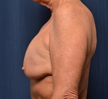Breast Implant Revision Before Photo by Michael Frederick, MD; Fort Lauderdale, FL - Case 36523