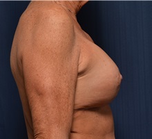 Breast Implant Revision After Photo by Michael Frederick, MD; Fort Lauderdale, FL - Case 36523