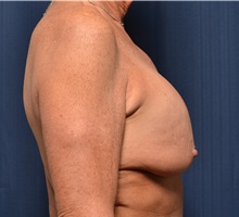 Breast Implant Revision Before Photo by Michael Frederick, MD; Fort Lauderdale, FL - Case 36523