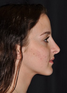 Rhinoplasty After Photo by Michael Frederick, MD; Fort Lauderdale, FL - Case 36554