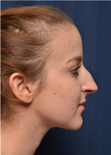 Rhinoplasty Before Photo by Michael Frederick, MD; Fort Lauderdale, FL - Case 36554