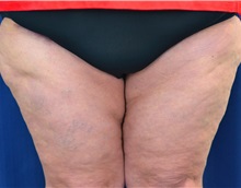 Thigh Lift After Photo by Michael Frederick, MD; Fort Lauderdale, FL - Case 36559