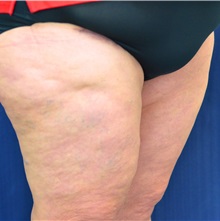 Thigh Lift After Photo by Michael Frederick, MD; Fort Lauderdale, FL - Case 36559