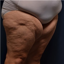 Thigh Lift Before Photo by Michael Frederick, MD; Fort Lauderdale, FL - Case 36559