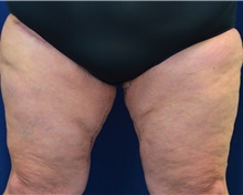 Thigh Lift After Photo by Michael Frederick, MD; Fort Lauderdale, FL - Case 36559