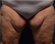Thigh Lift Before Photo by Michael Frederick, MD; Fort Lauderdale, FL - Case 36559